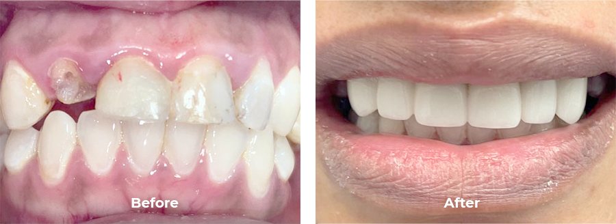 before and after of a patient's teeth