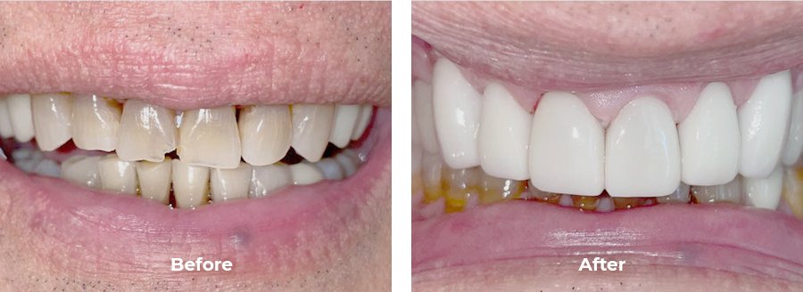 before and after of a patient's teeth