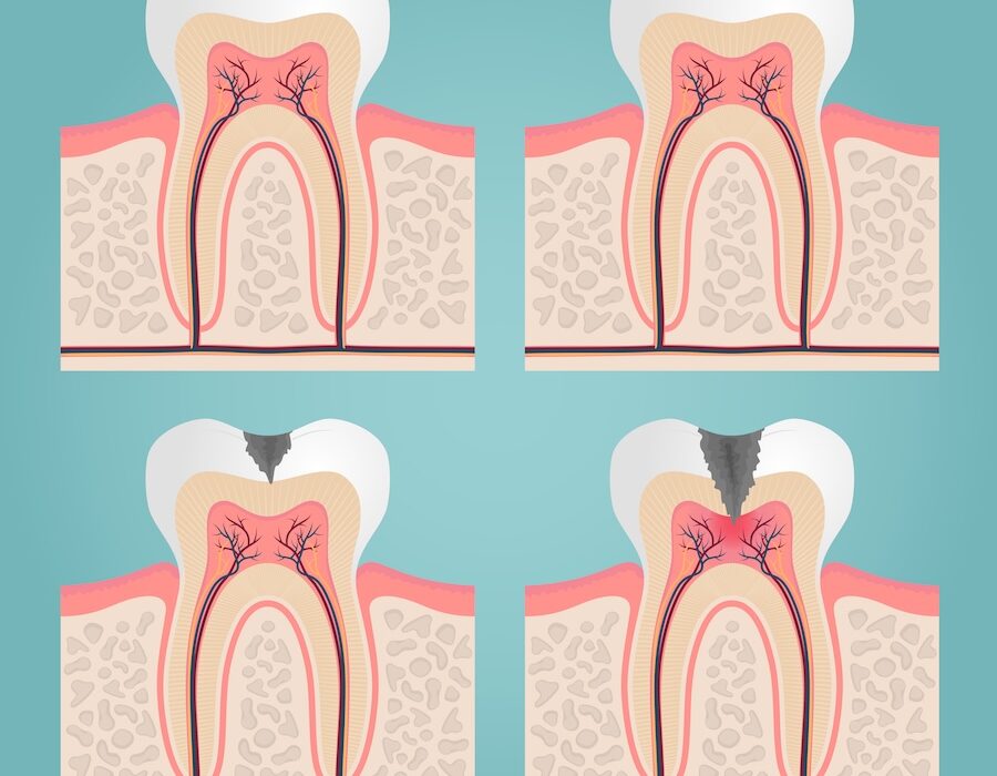 early signs of cavities